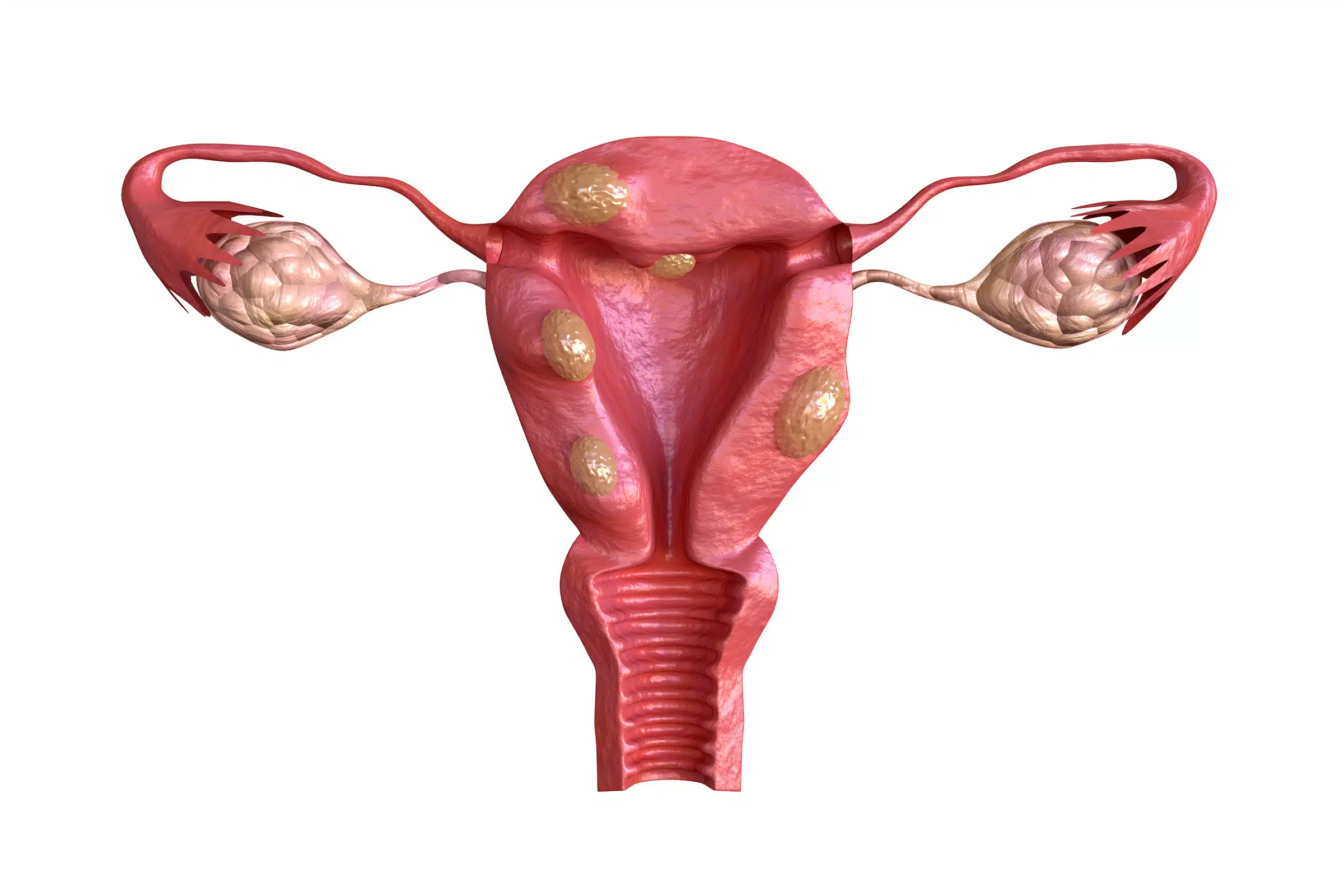 Dispelling Myths About Fibroids